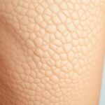 tratamento para celulite